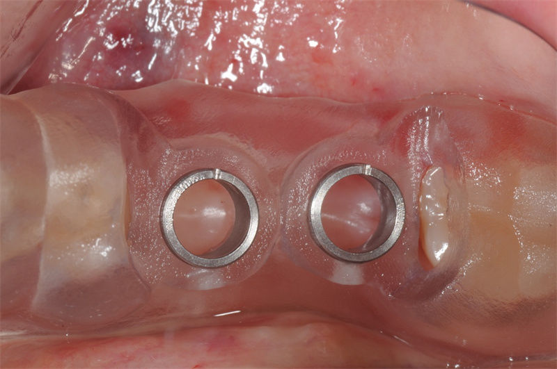 局部牙支持式導板